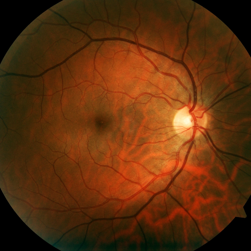 Digital Retinal Imaging